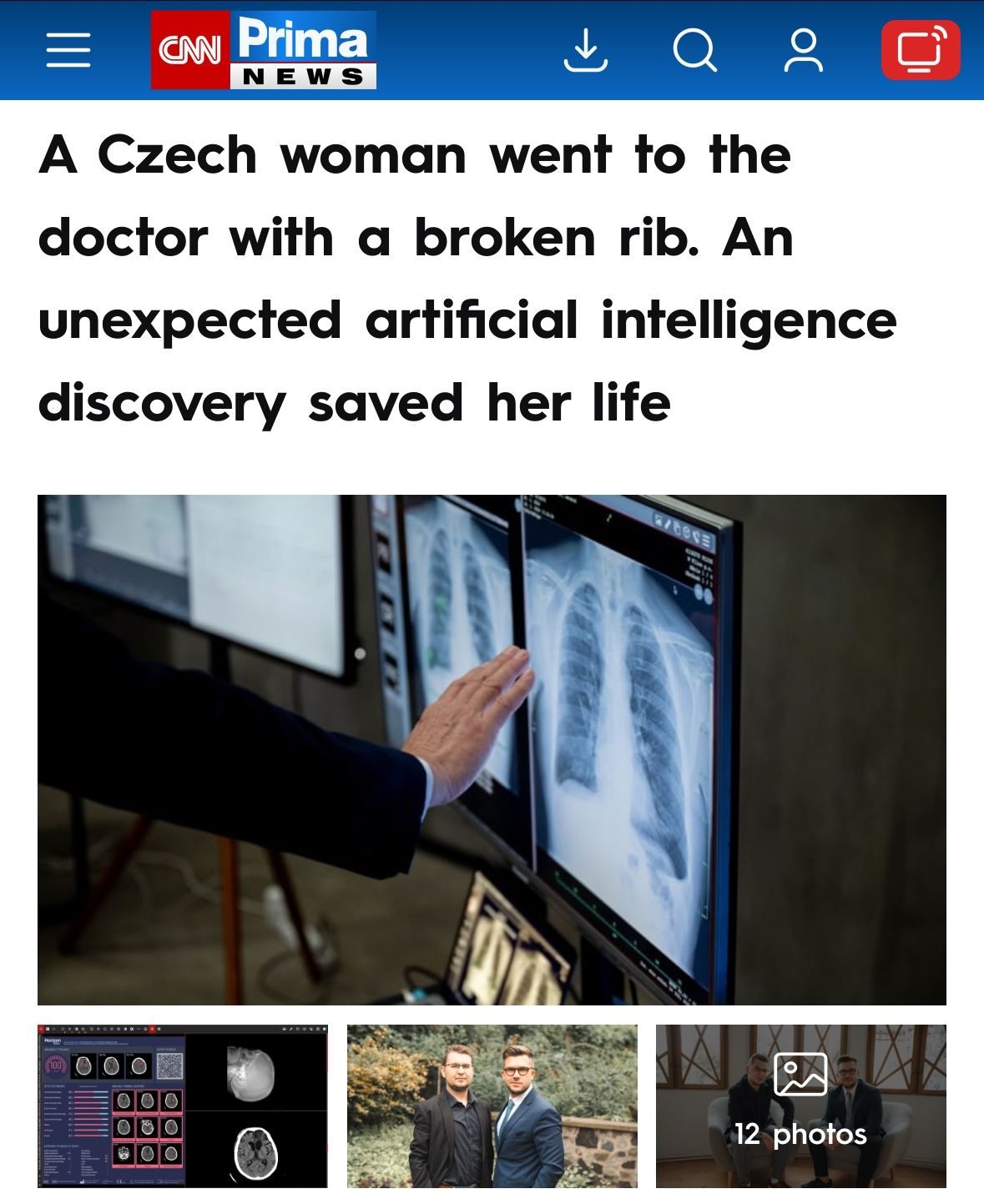 CNN Prima NEWS — A Czech woman went to the doctor with a broken rib. An unexpected AI discovery saved her life